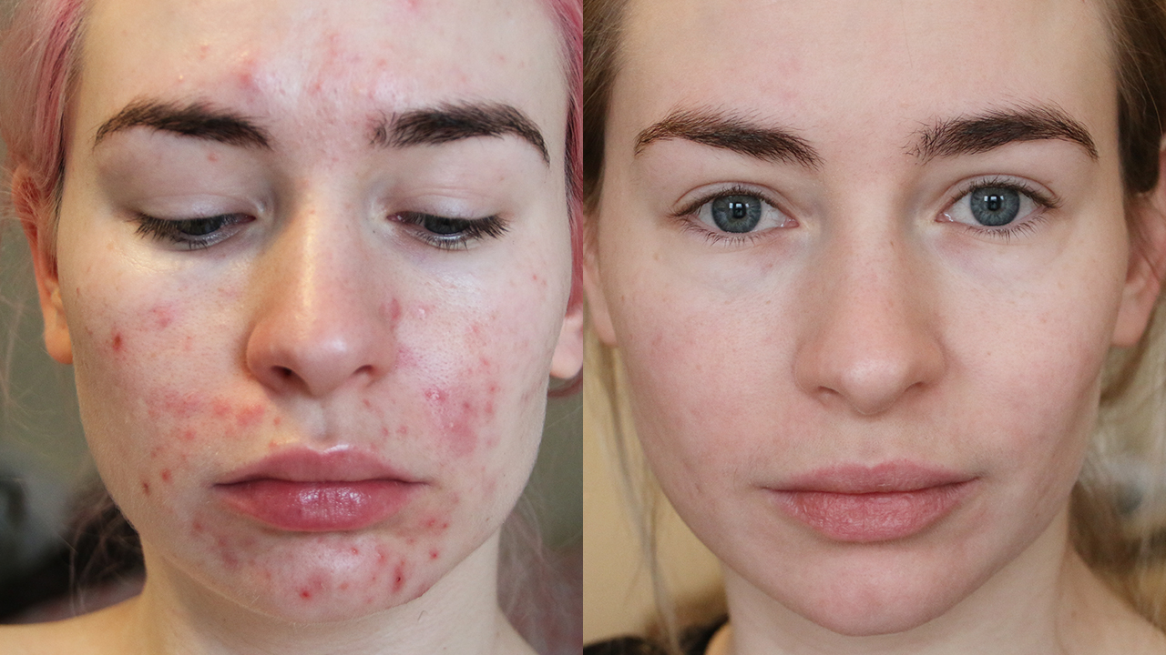 roaccutane journey